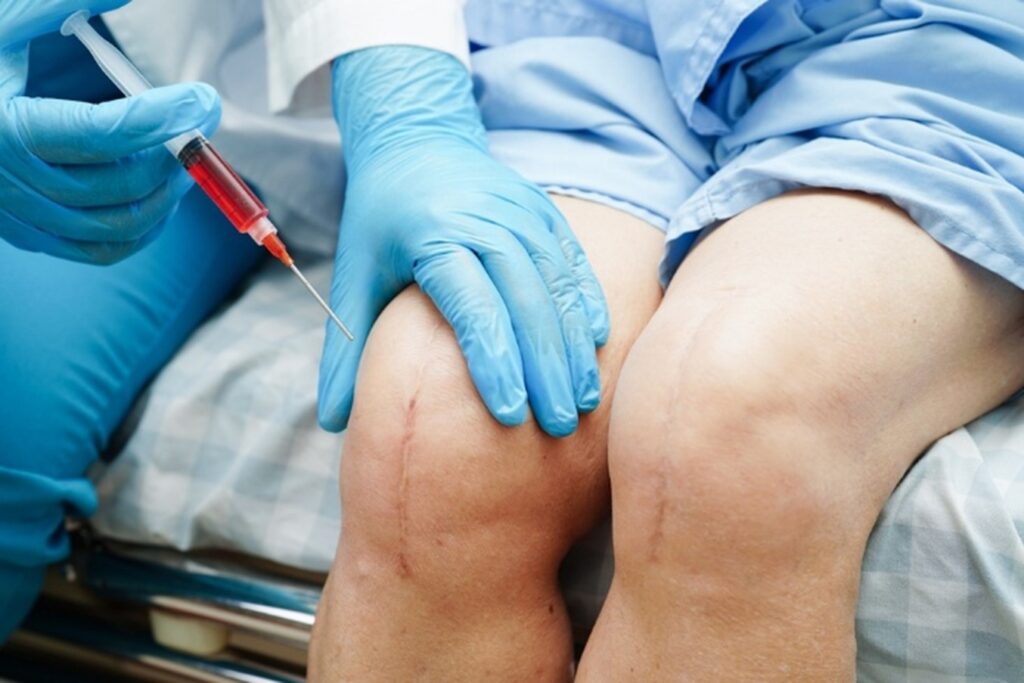 PRP for tendinopathy in Nashville